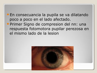En consecuancia la pupila se va dilatando
poco a poco en el lado afectado.
Primer Signo de compresion del nn: una
respuesta fotomotora pupilar perezosa en
el mismo lado de la lesion
 