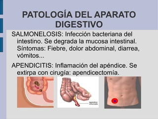 PATOLOGÍA DEL APARATO
DIGESTIVO
SALMONELOSIS: Infección bacteriana del
intestino. Se degrada la mucosa intestinal.
Síntomas: Fiebre, dolor abdominal, diarrea,
vómitos...
APENDICITIS: Inflamación del apéndice. Se
extirpa con cirugía: apendicectomía.
 