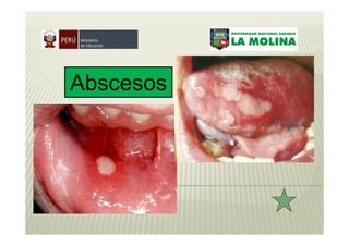 Abscesos
 