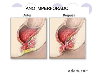 ANO IMPERFORADO

 