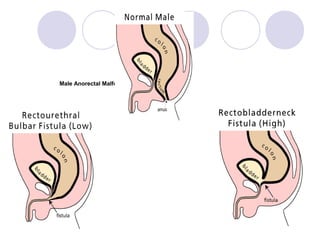Male Anorectal Malformations:

 