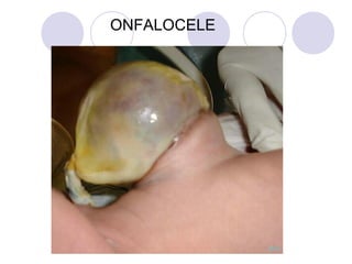 ONFALOCELE

 