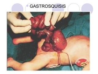 GASTROSQUISIS

 