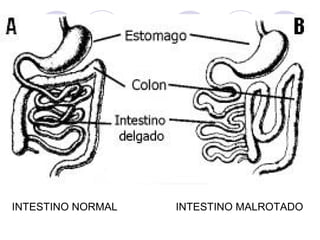 INTESTINO NORMAL

INTESTINO MALROTADO

 