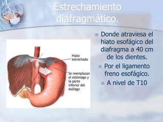Estrechamiento 
diafragmático. 
 Donde atraviesa el 
hiato esofágico del 
diafragma a 40 cm 
de los dientes. 
 Por el ligamento 
freno esofágico. 
 A nivel de T10 
 