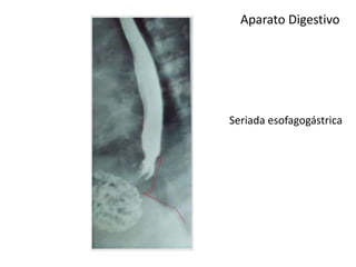 Aparato Digestivo
Seriada esofagogástrica
 