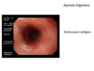 Aparato Digestivo
Endoscopía esofágica
 