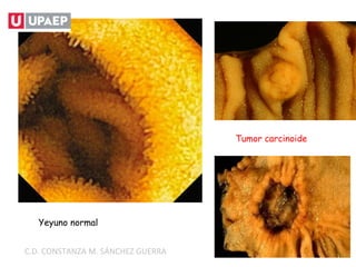 Yeyuno normal
Tumor carcinoide
C.D. CONSTANZA M. SÁNCHEZ GUERRA
 
