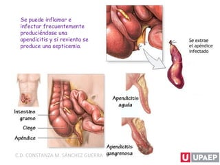 Se puede inflamar e
infectar frecuentemente
produciéndose una
apendicitis y si revienta se
produce una septicemia.
C.D. CONSTANZA M. SÁNCHEZ GUERRA
 