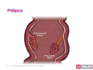 Pólipos
C.D. CONSTANZA M. SÁNCHEZ GUERRA
 
