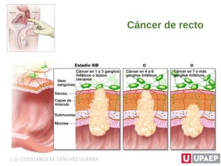 Cáncer de recto
C.D. CONSTANZA M. SÁNCHEZ GUERRA
 
