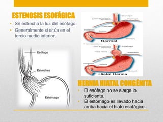 ESTENOSIS ESOFÁGICA 
• Se estrecha la luz del esófago. 
• Generalmente si sitúa en el 
tercio medio inferior. 
HERNIA HIATAL CONGÉNITA 
• El esófago no se alarga lo 
suficiente. 
• El estómago es llevado hacia 
arriba hacia el hiato esofágico. 
 