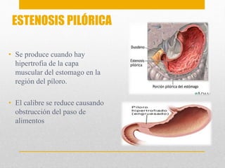 ESTENOSIS PILÓRICA 
• Se produce cuando hay 
hipertrofia de la capa 
muscular del estomago en la 
región del píloro. 
• El calibre se reduce causando 
obstrucción del paso de 
alimentos 
 