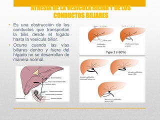 ATRESIA DE LA VESÍCULA BILIAR Y DE LOS 
CONDUCTOS BILIARES 
• Es una obstrucción de los 
conductos que transportan 
la bilis desde el hígado 
hasta la vesícula biliar. 
• Ocurre cuando las vías 
biliares dentro y fuera del 
hígado no se desarrollan de 
manera normal. 
 