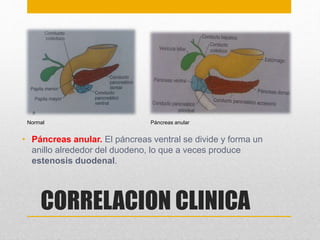 Normal Páncreas anular 
• Páncreas anular. El páncreas ventral se divide y forma un 
anillo alrededor del duodeno, lo que a veces produce 
estenosis duodenal. 
CORRELACION CLINICA 
 
