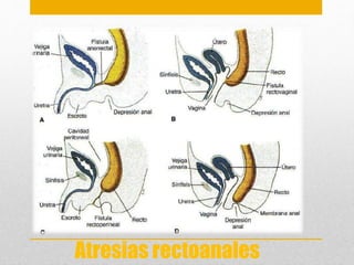• Formación del 
intestino incompleta 
Atresias rectoanales 
