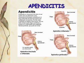 APENDICITIS 