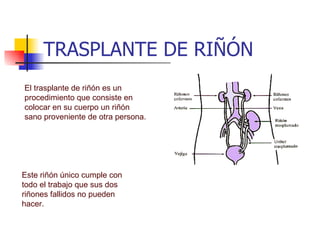 TRASPLANTE DE RIÑÓN El trasplante de riñón es un procedimiento que consiste en colocar en su cuerpo un riñón sano proveniente de otra persona.  Este riñón único cumple con todo el trabajo que sus dos riñones fallidos no pueden hacer. 