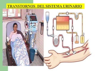TRANSTORNOS DEL SISTEMA URINARIO 
 