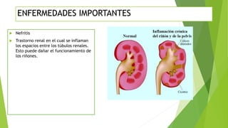 ENFERMEDADES IMPORTANTES
 Nefritis
 Trastorno renal en el cual se inflaman
los espacios entre los túbulos renales.
Esto puede dañar el funcionamiento de
los riñones.
 