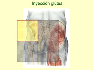 Inyección glútea 