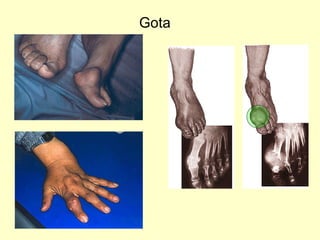 Gota 