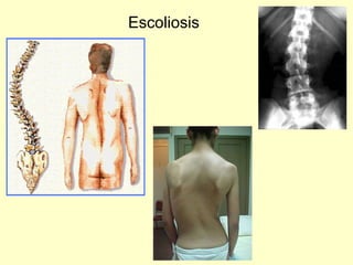 Escoliosis 