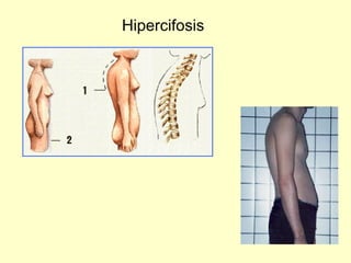Hipercifosis 
