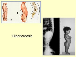 Hiperlordosis 