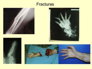 Fracturas 