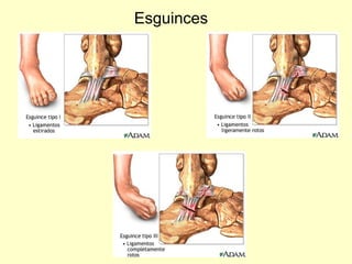 Esguinces 