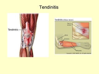 Tendinitis 