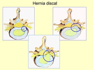 Hernia discal 