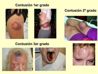 Contusión 1er grado Contusión 2º grado Contusión 3er grado 