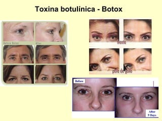 Toxina botulínica - Botox 