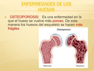ENFERMEDADES DE LOS
HUESOS
 OSTEOPOROSIS: Es una enfermedad en la
que el hueso se vuelve más poroso. De esta
manera los huesos del esqueleto se hacen más
frágiles
 