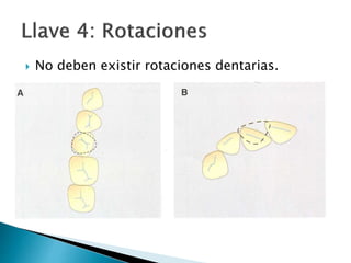  No deben existir rotaciones dentarias.
 