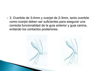  3. Overbite de 3-4mm y overjet de 2-3mm, tanto overbite
como overjet deben ser suficientes para asegurar una
correcta funcionalidad de la guia anterior y guia canina,
evitando los contactos posteriores.
 