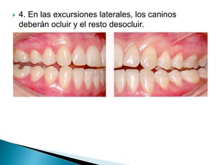  4. En las excursiones laterales, los caninos
deberán ocluir y el resto desocluir.
 
