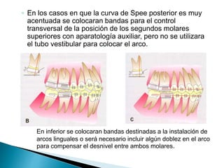 ◦ En los casos en que la curva de Spee posterior es muy
acentuada se colocaran bandas para el control
transversal de la posición de los segundos molares
superiores con aparatología auxiliar, pero no se utilizara
el tubo vestibular para colocar el arco.
En inferior se colocaran bandas destinadas a la instalación de
arcos linguales o será necesario incluir algún doblez en el arco
para compensar el desnivel entre ambos molares.
 