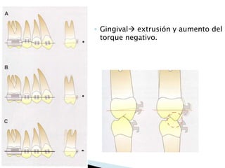 ◦ Gingival extrusión y aumento del
torque negativo.
 