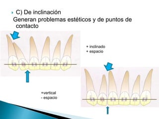  C) De inclinación
Generan problemas estéticos y de puntos de
contacto
+ inclinado
+ espacio
+vertical
- espacio
 