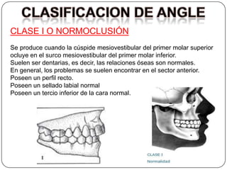 CLASE I O NORMOCLUSIÓN
Se produce cuando la cúspide mesiovestibular del primer molar superior
ocluye en el surco mesiovestibular del primer molar inferior.
Suelen ser dentarias, es decir, las relaciones óseas son normales.
En general, los problemas se suelen encontrar en el sector anterior.
Poseen un perfil recto.
Poseen un sellado labial normal
Poseen un tercio inferior de la cara normal.
 