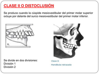 CLASE II O DISTOCLUSIÓN
Se produce cuando la cúspide mesiovestibular del primer molar superior
ocluye por delante del surco mesiovestibular del primer molar inferior.




Se divide en dos divisiones:
División 1
División 2
 