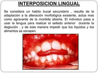 INTERPOSICION LINGUAL
Se considera un habito bucal secundario , resulta de la
adaptación a la alteración morfológica existente, actúa mas
como agravante de la mordida abierta. El individuo pasa a
usar la lengua para realizar el sellado anterior durante la
deglución , y de esta manera impedir que los líquidos y los
alimentos se escapen.
 