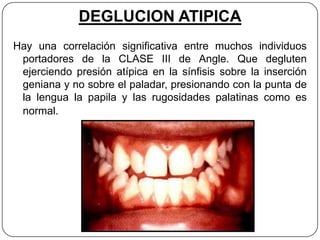 DEGLUCION ATIPICA
Hay una correlación significativa entre muchos individuos
 portadores de la CLASE III de Angle. Que degluten
 ejerciendo presión atípica en la sínfisis sobre la inserción
 geniana y no sobre el paladar, presionando con la punta de
 la lengua la papila y las rugosidades palatinas como es
 normal.
 