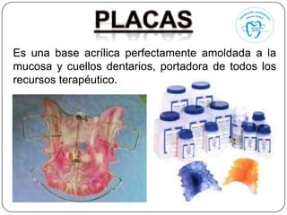 Es una base acrílica perfectamente amoldada a la
mucosa y cuellos dentarios, portadora de todos los
recursos terapéutico.
 