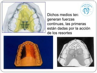 Dichos medios terapéuticos
generan fuerzas
continuas, las primeras
están dadas por la acción
de los resortes
 