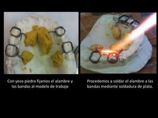 Con yeso piedra fijamos el alambre y
las bandas al modelo de trabajo
Procedemos a soldar el alambre a las
bandas mediante soldadura de plata.
 