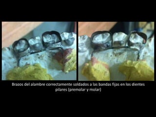 Brazos del alambre correctamente soldados a las bandas fijas en los dientes
pilares (premolar y molar)
 